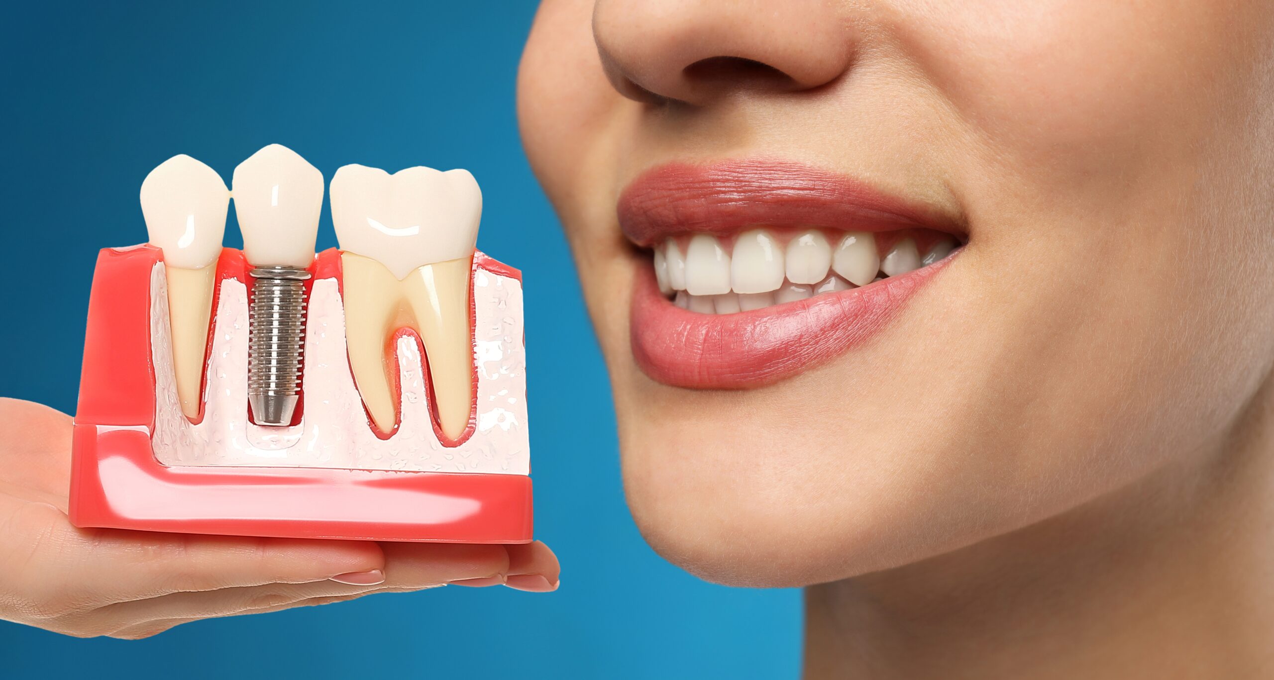 Γιατί τα εμφυτεύματα μπορεί να είναι η απάντηση στα δόντια που λείπουν