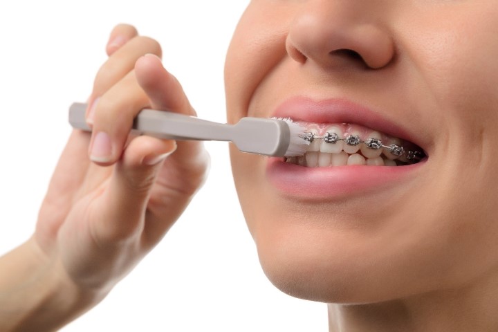 Πώς να φροντίζετε τα δόντια σας κατά τη διάρκεια της ορθοδοντικής θεραπείας